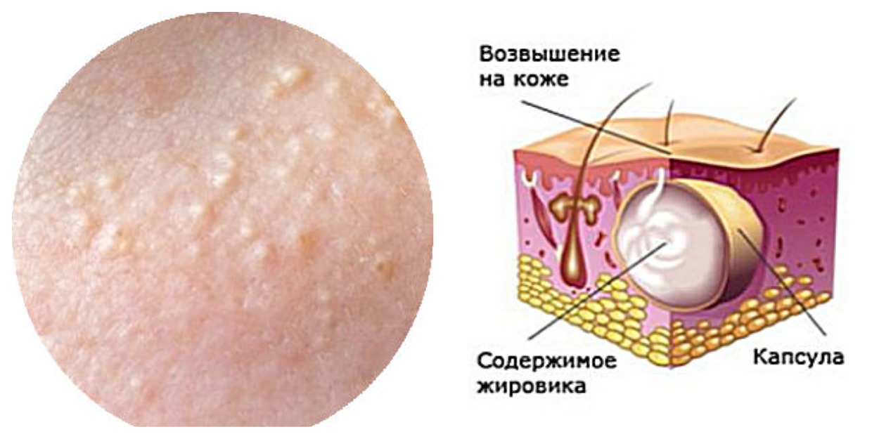 Базалиома кожи лица: лечение, как выглядит базалиома кожи лица, чем опасна базалиома кожи лица | клиники «евроонко»