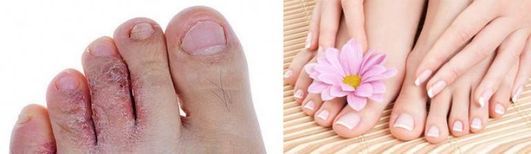Трещины между пальцами ног: причины и лечение в домашних условиях
