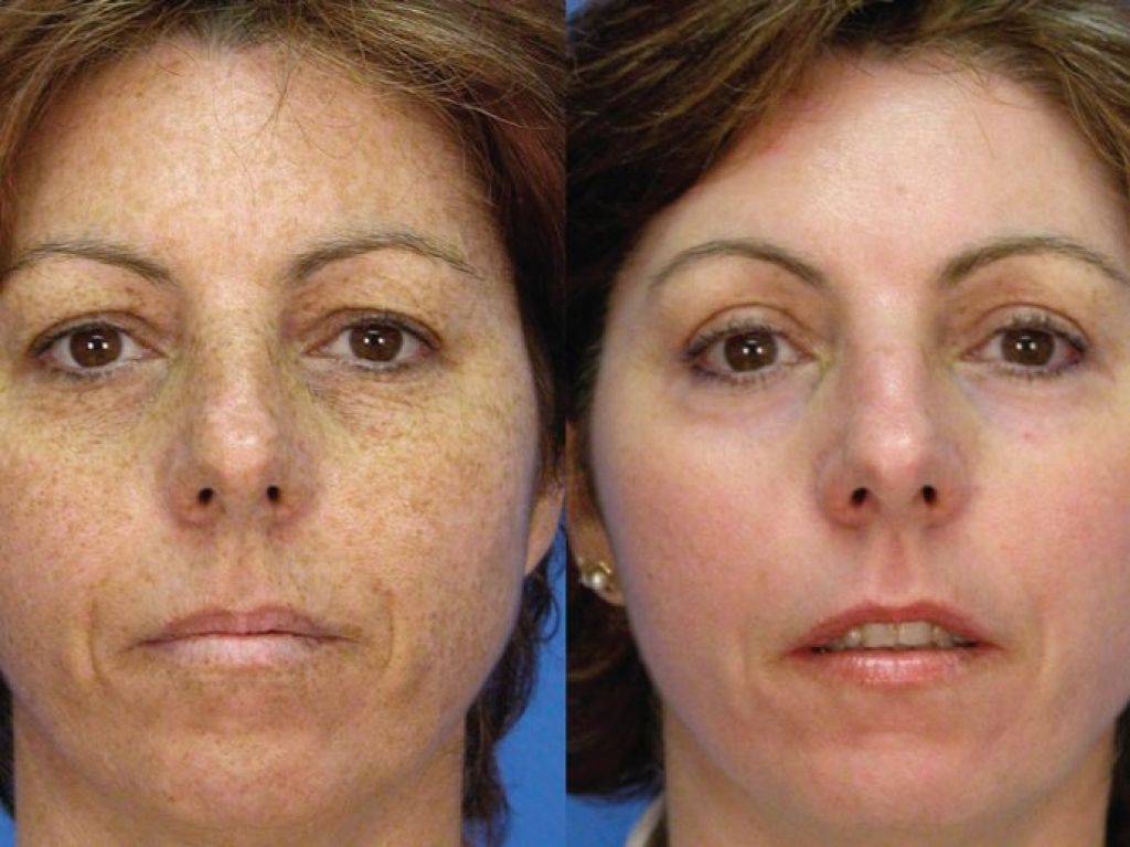 Фотоомоложение лица: плюсы и минусы процедуры, как проводится в клинике косметологии «а клиника»