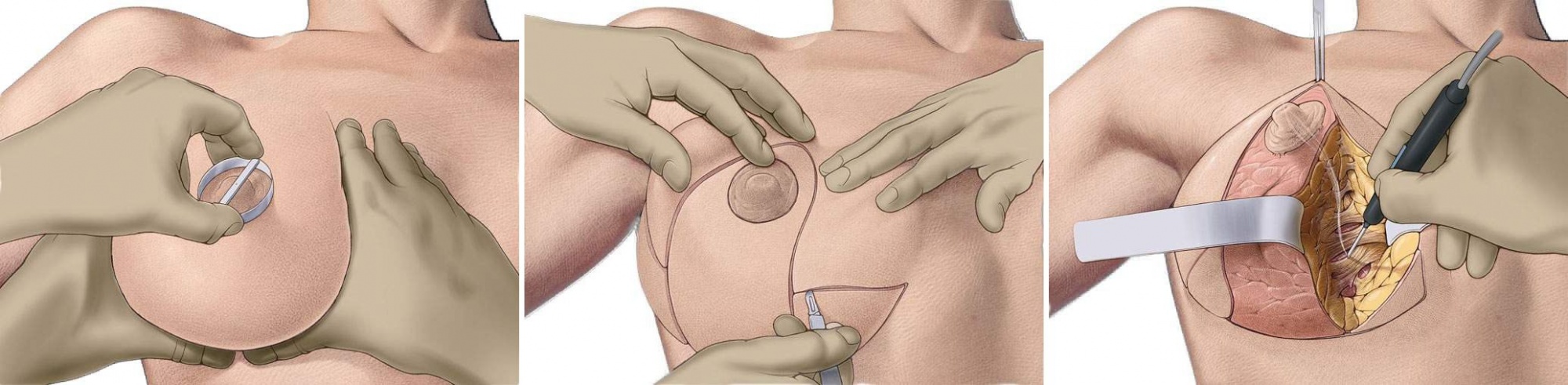 Подтяжка грудных желез, подтяжка груди, мастопексия – us clinic - клиника доктора юсупова