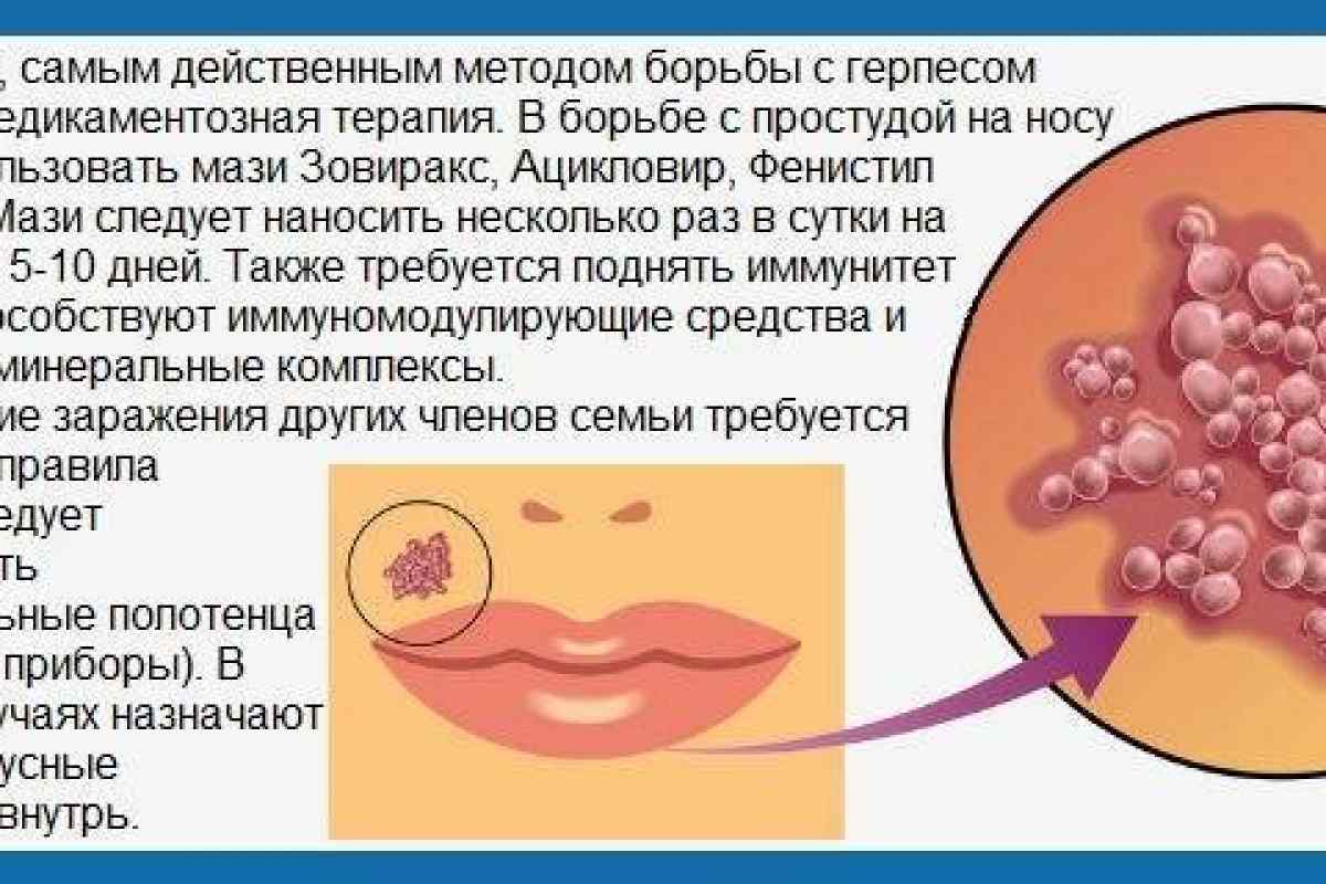 Герпес на лице: причины, виды, симптомы, лечение, последствия