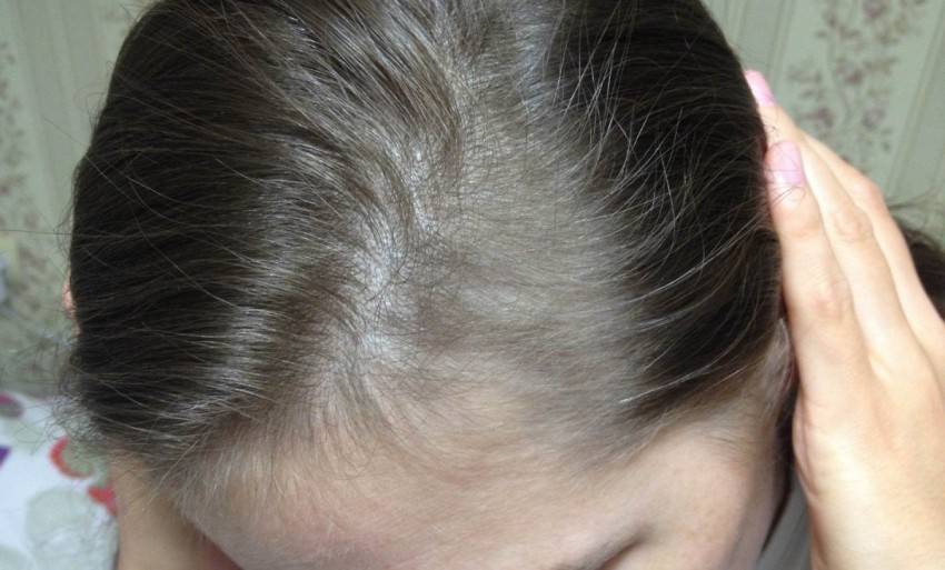 Выпадают волосы после родов: что делать, причины, лечение / mama66.ru