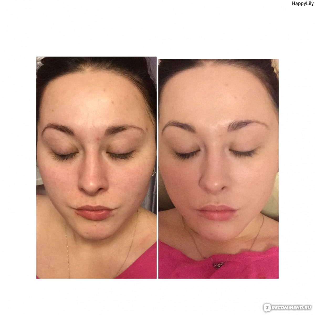 Bb glow: что это такое и как проходит эта процедура