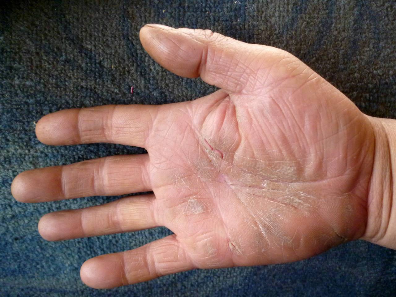 Как устранить трещины на пальцах рук