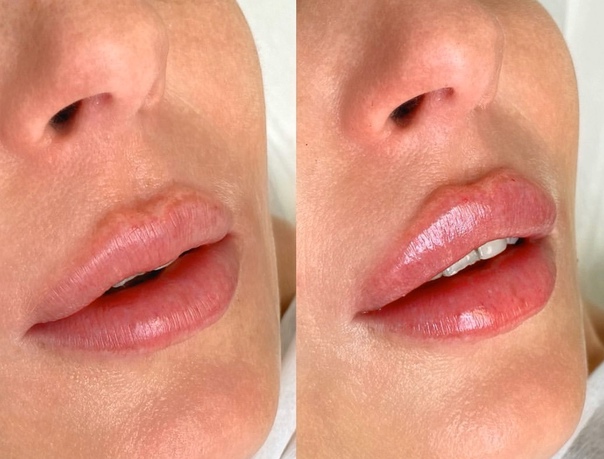 Последствия увеличения губ гиалоурановой кислотой: ошибки, осложнения после введения филлера в губы