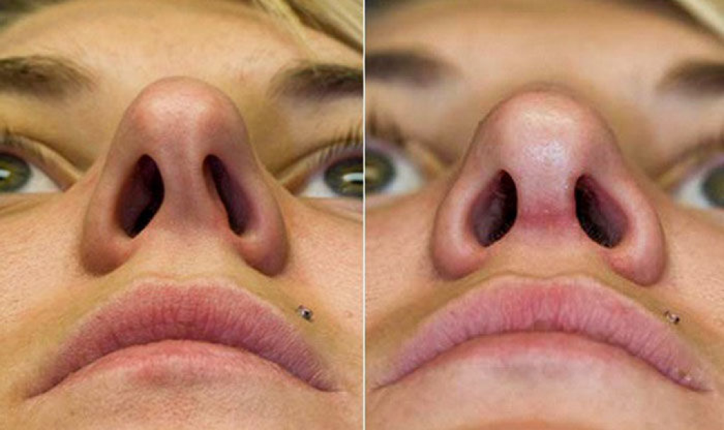 Септопластика и операции на носовой перегородке