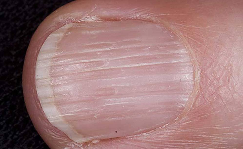 Причины появления продольных и поперечных полос и точек на ногтях, способы лечения и профилактика