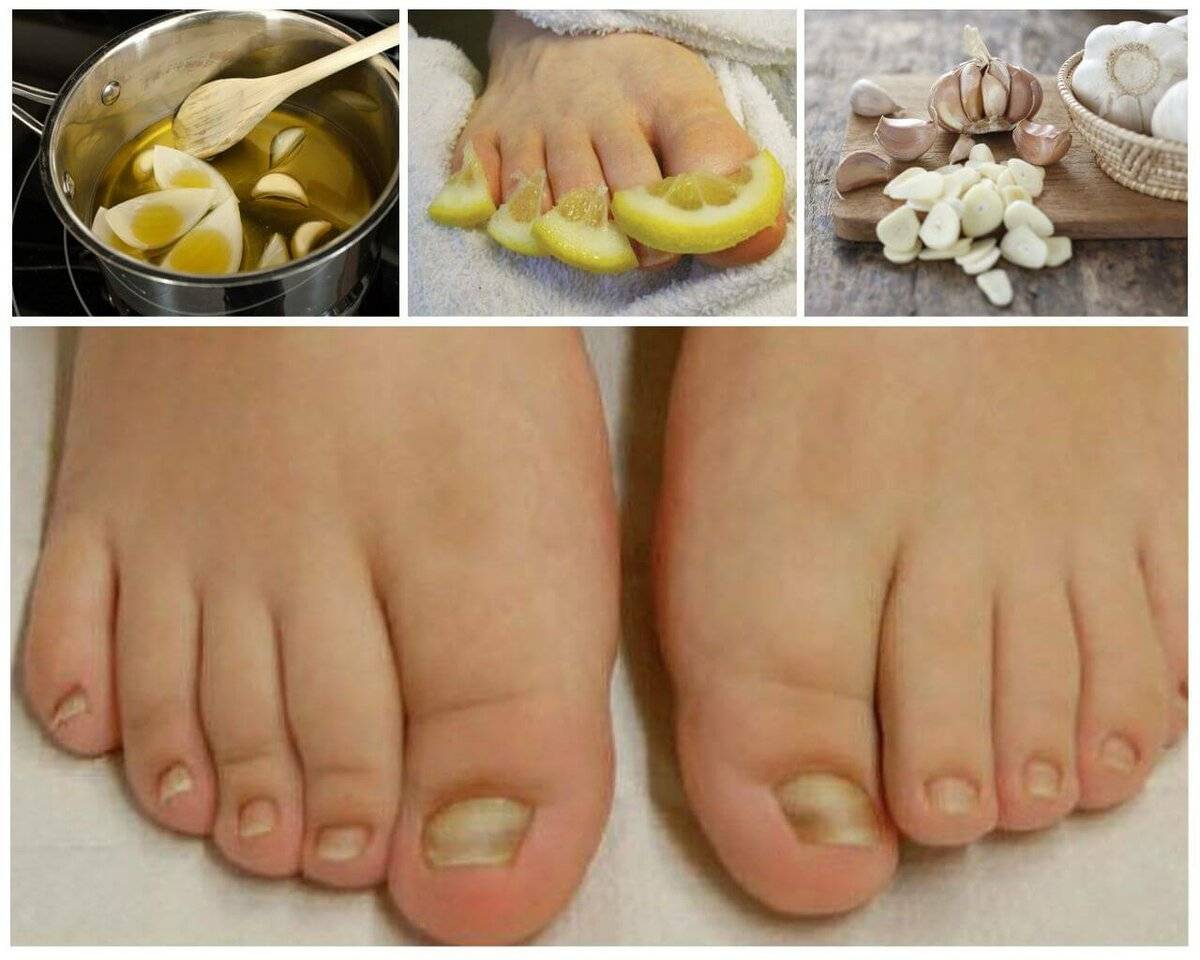 Грибок ногтей на ногах: 110 фото как выглядит и описание чем лечить грибок