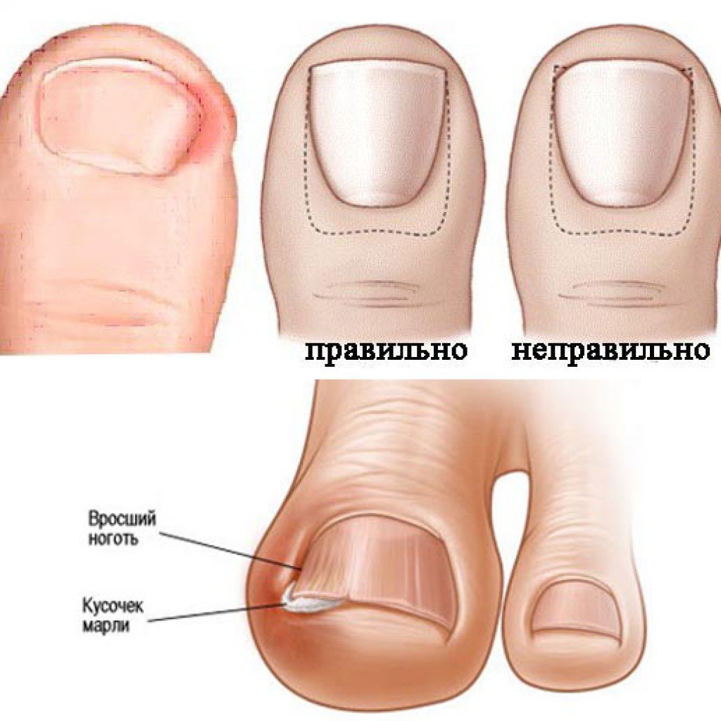 Болит большой палец на ноге | причины боли пальца на ноге, диагностика и лечение
