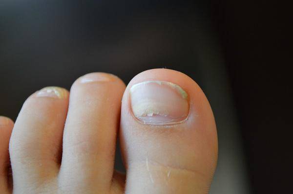 Травма ногтя - что нужно знать мастеру красоты • журнал nails