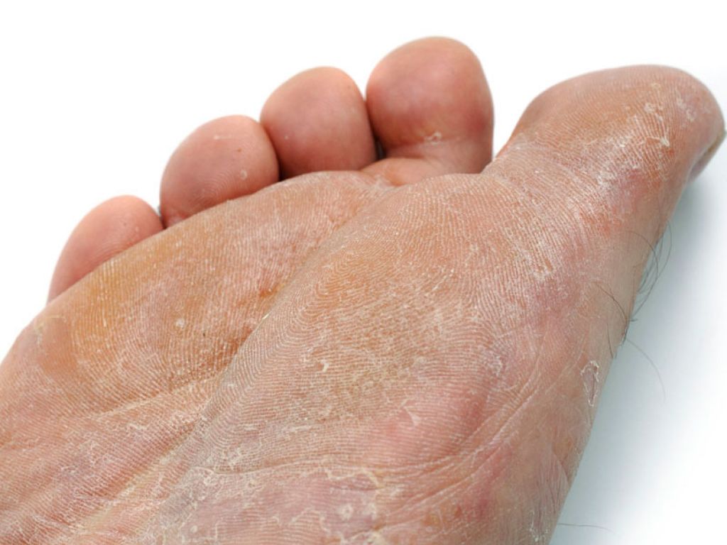 Сухая кожа на ногах ниже колен сильно шелушится: причины, лечение и что делать