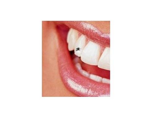 Скайсы из украшения для зубов для взрослых превратились в общее увлечение молодежи