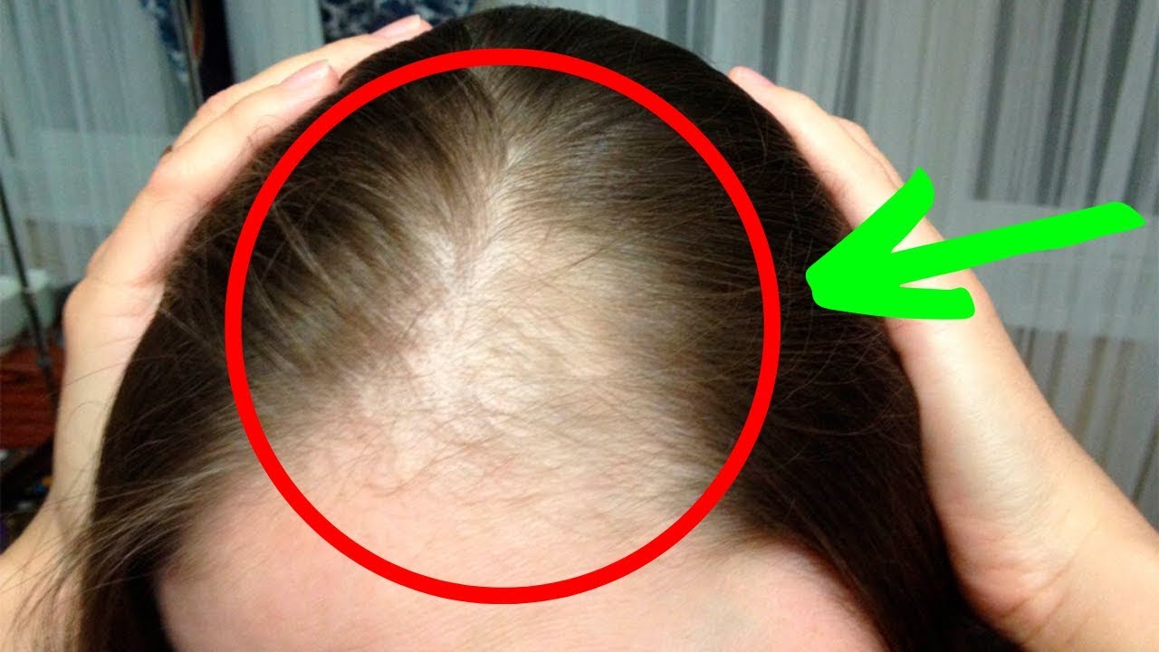 Причины выпадения волос и лечение в санкт-петербурге