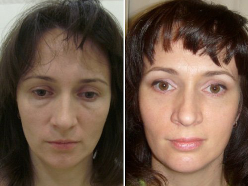 Блефаропластика: все, что вы хотели знать, но не у кого спросить