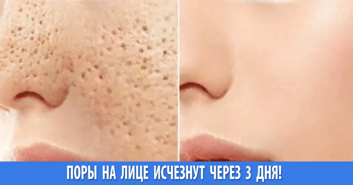 Расширенные поры на лице – решение проблемы (топ-методы)