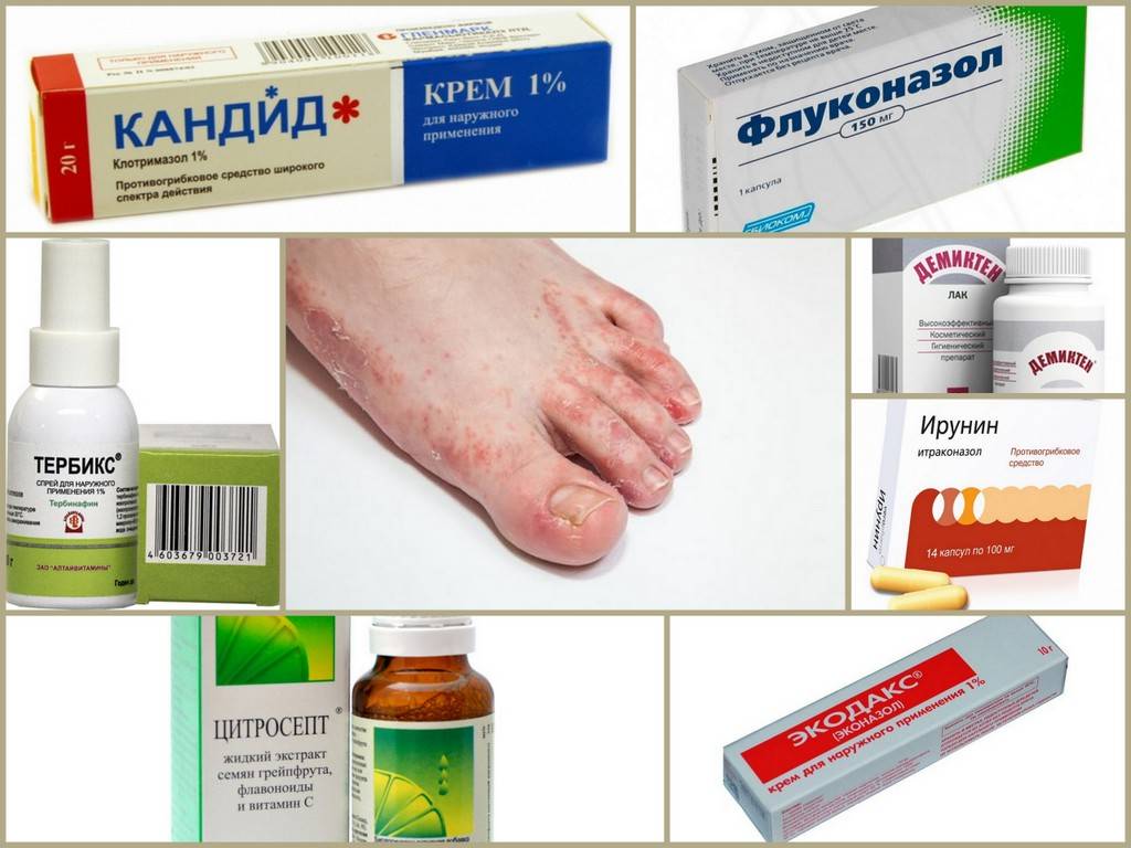 Онихомикоз (грибок ногтя) - причины, симптомы, диагностика, лечение и профилактика