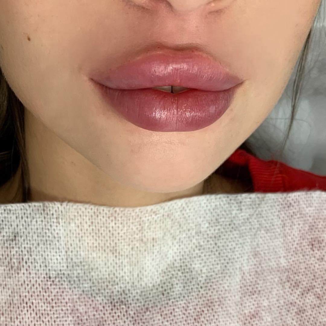 Фото красивых губ после увеличения