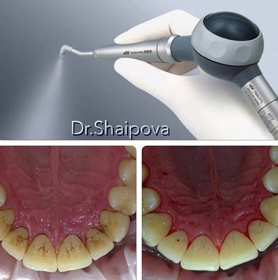 Процедура air flow – прогрессивный уход за поверхностью зубов