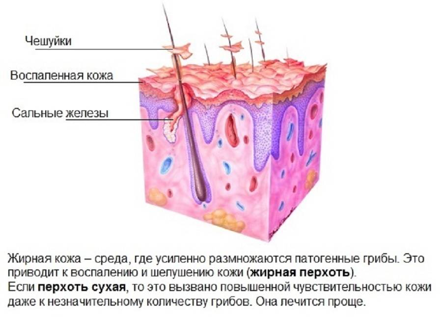 Себорея схема лечения