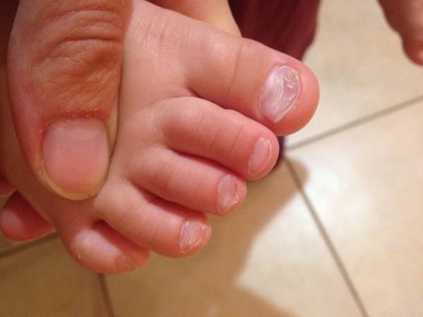 У ребенка слоятся ногти на ногах: причины и как их быстро вылечить