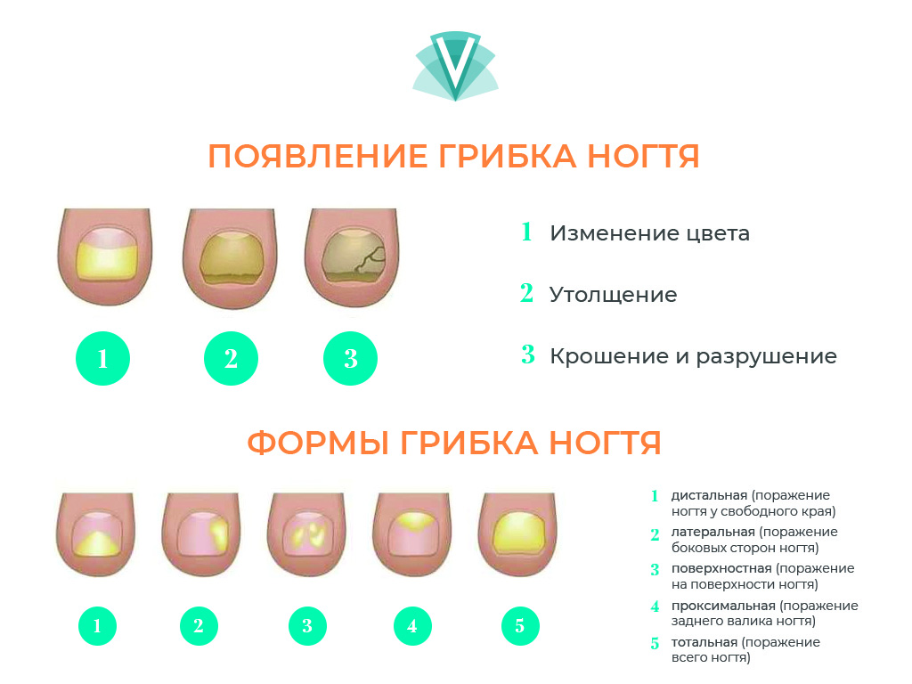 Онихомикоз (грибок ногтей): топ методов лечения и профилактики