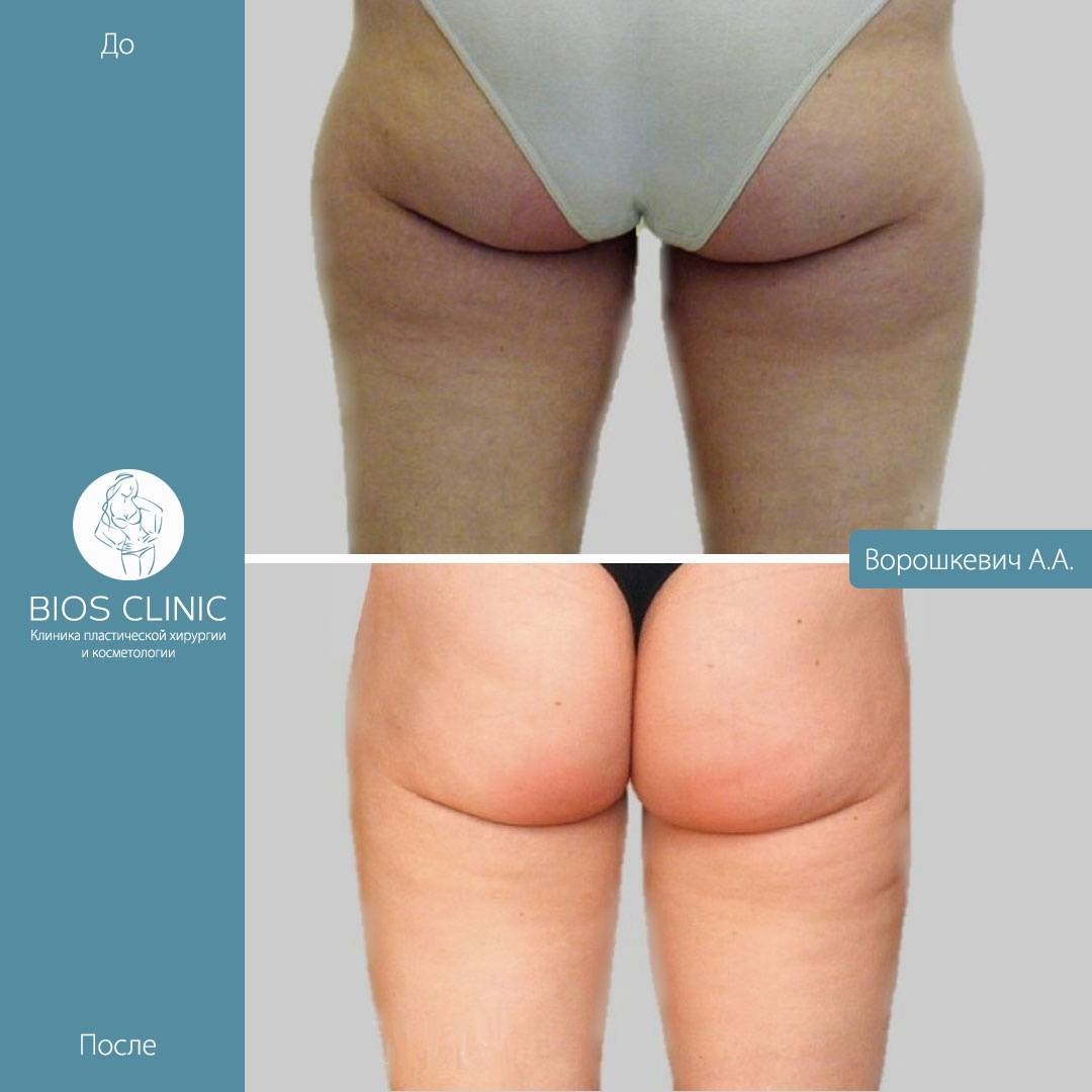 Липосакция бёдер, толстых ног у женщин. Фото до и после, цена, отзывы