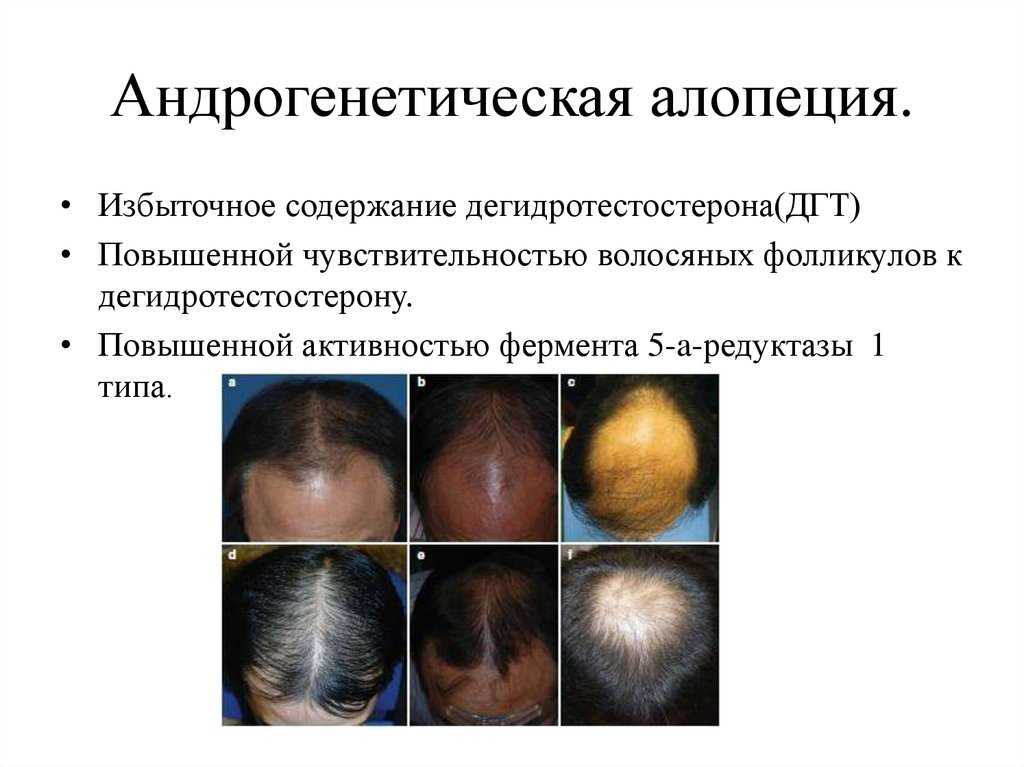 Андрогенное облысение и алопеция у женщин - как вылечить андрогенное выпадение волос у женщин