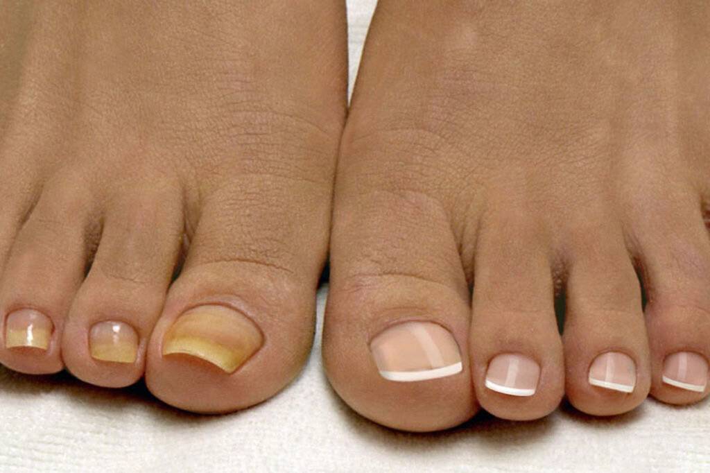 Как выглядит и почему возникает грибок ногтей на ногах?