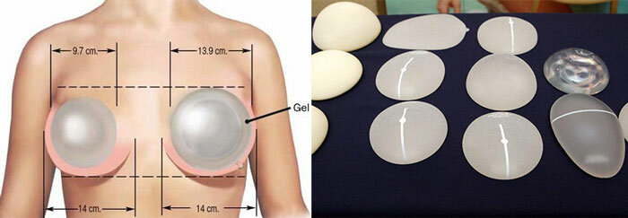 Интересное | отёк груди после маммопластики