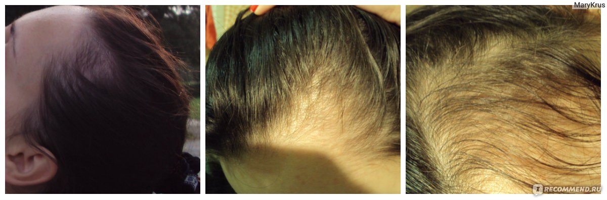 Уход за волосами после родов: выпадение волос и окрашивании при грудном вскармливании