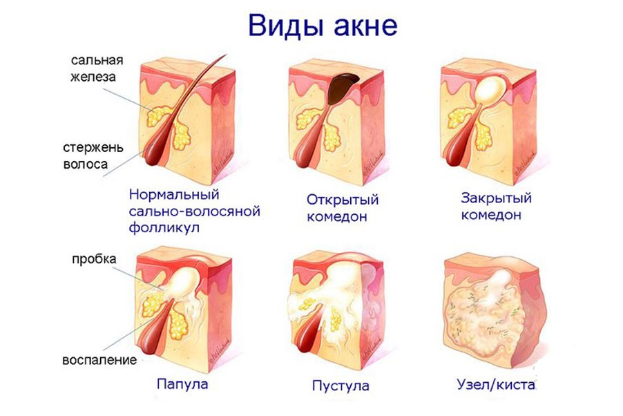Гормональные прыщи у женщин на лице и на лбу: причины возникновения, как лечить и избавиться от гормонального акне | романов георгий никитич