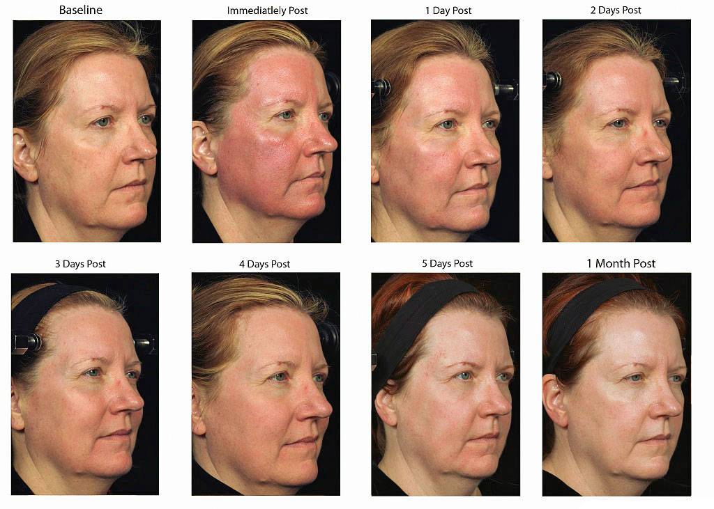 Отзывы с фото до и после на лазерный пилинг лица