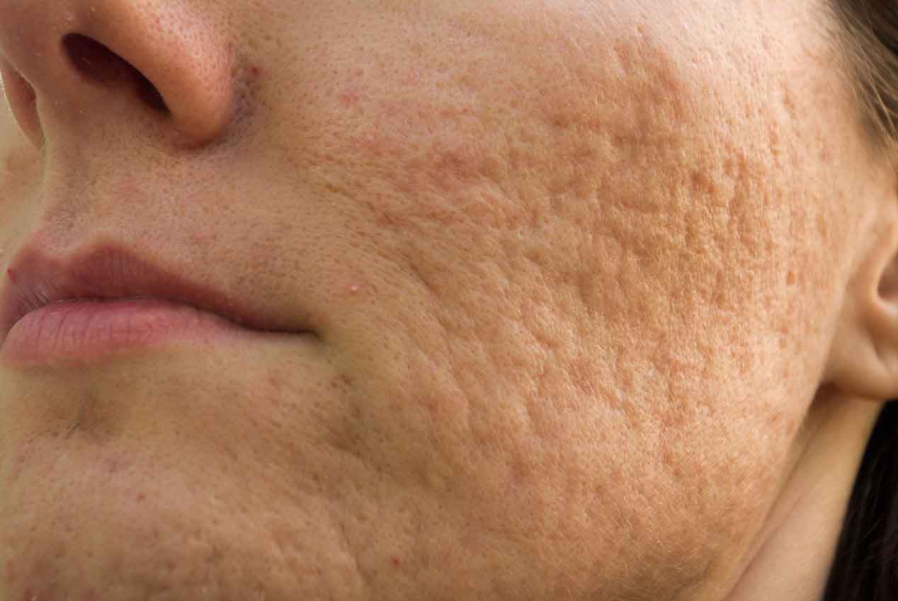 Лечение шрамов и рубцов на лице и теле - способы борьбы с несовершенствами