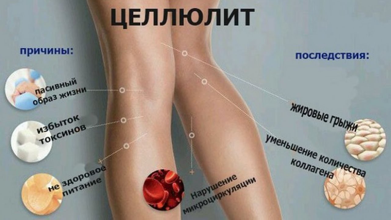 Целлюлит: почему появляется у женщин, почему не уходит