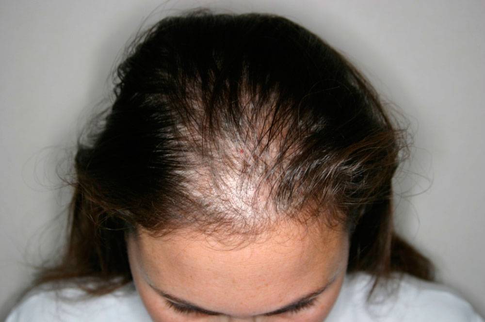 Выпадают волосы после родов: основные причины и методы лечения