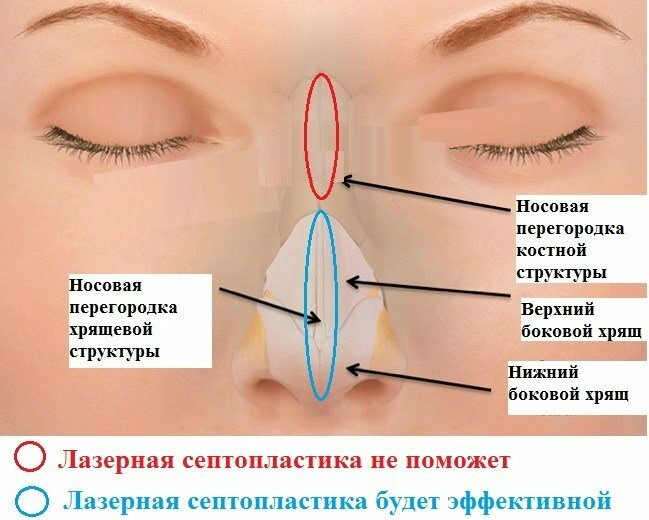 Исправление перегородки носа, операция по искривлению лазером * как делают выравнивание