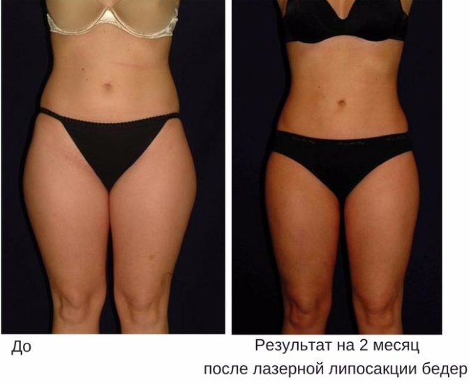 Отзывы до и после липолитиков для похудения живота и других частей тела
