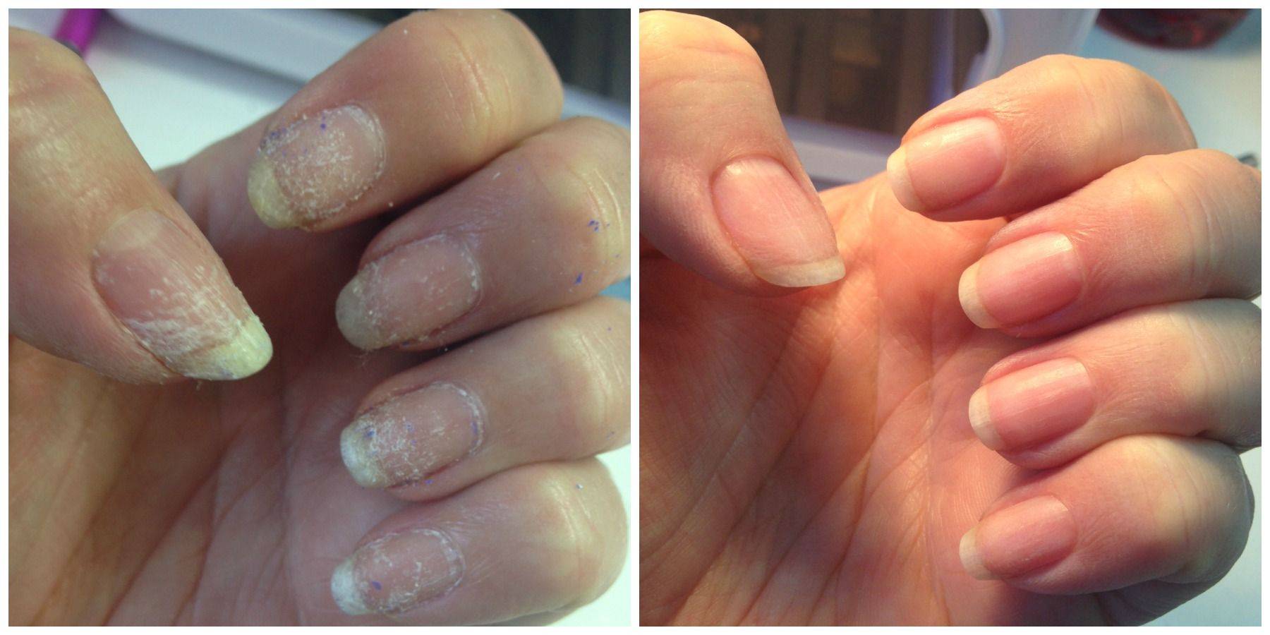 Как восстановить ногти после гель-лака в домашних условиях?
