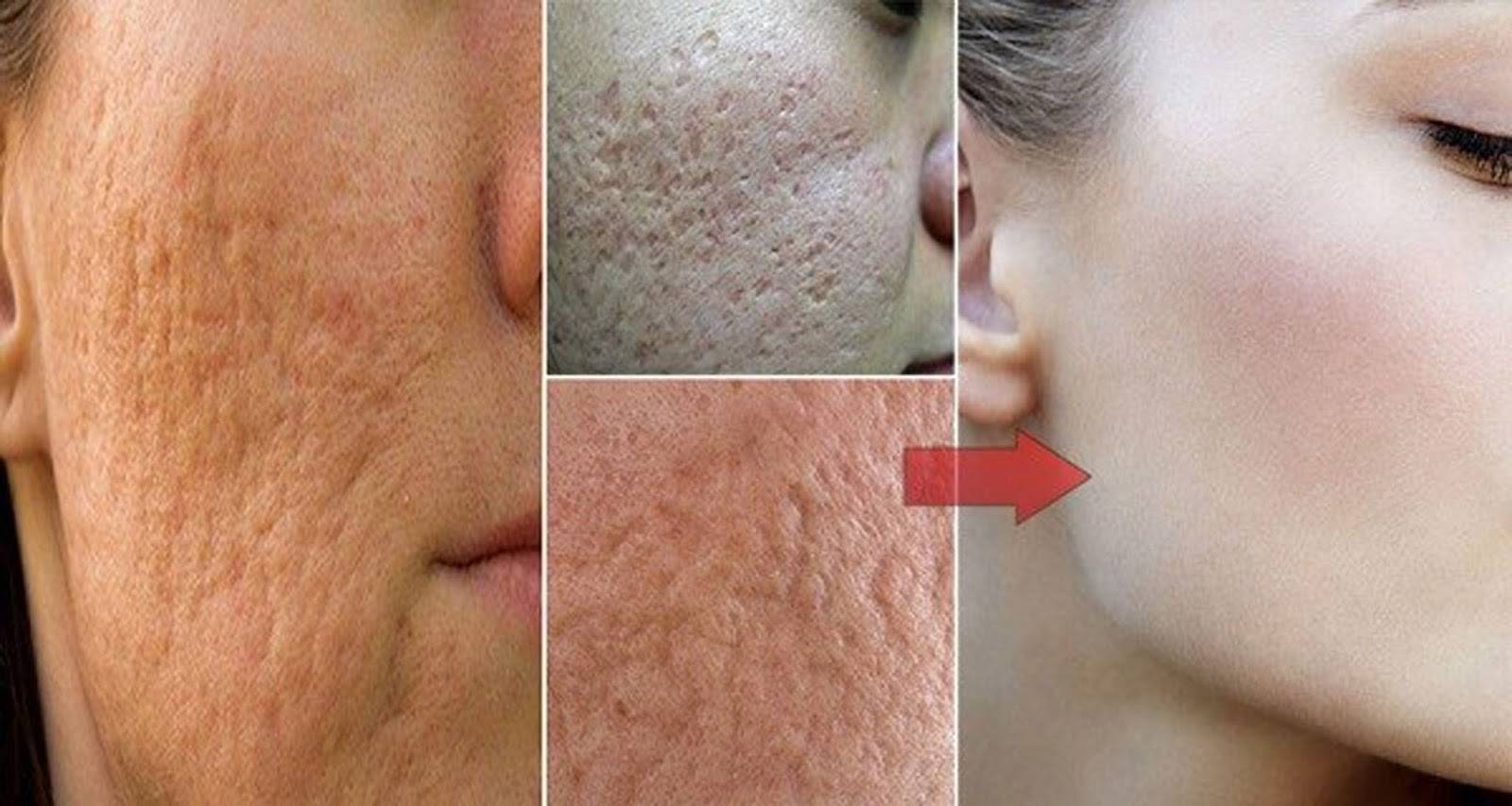 Крупные поры на лице, что делать: как замаскировать расширенные поры на коже лица