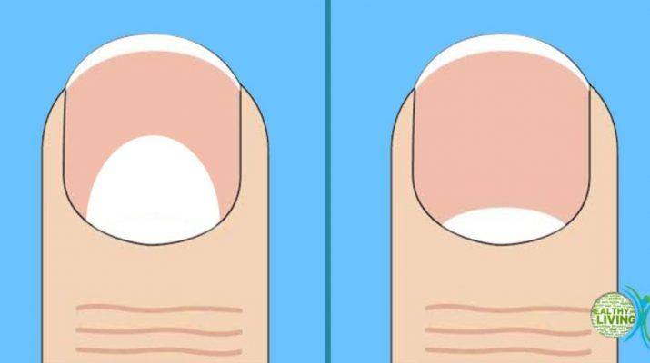 Отслоение ногтя — меры профилактики и лечение