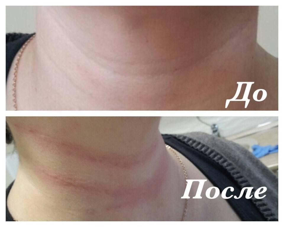 Кольца венеры на шее - значение, причины, влияние на жизнь