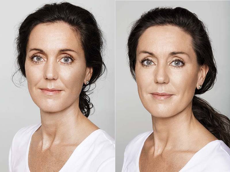 Филлер радиесс для лица эффект до и после фото