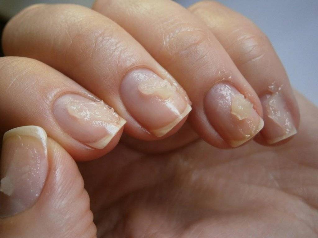 Как восстановить ногти после наращивания: способы