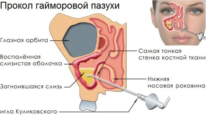 Прокол при гайморите: показания, ход процедуры, восстановление