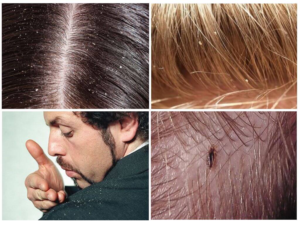 Атерома головы: причины, симптомы, лечение. красивое удаление атеромы на голове без бритья волос