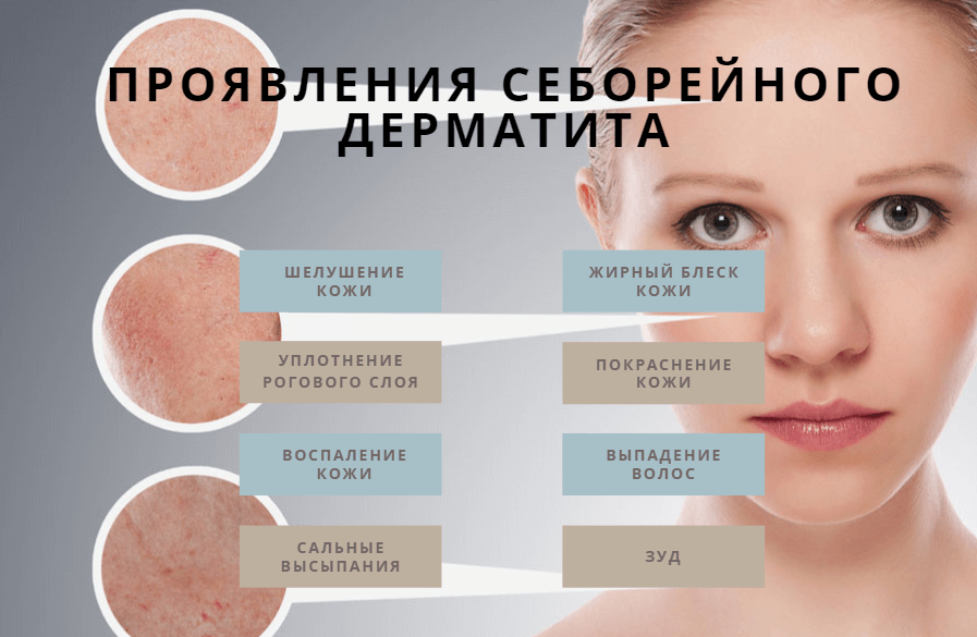 Себорея - причины, виды, симптомы, диагностика и лечение