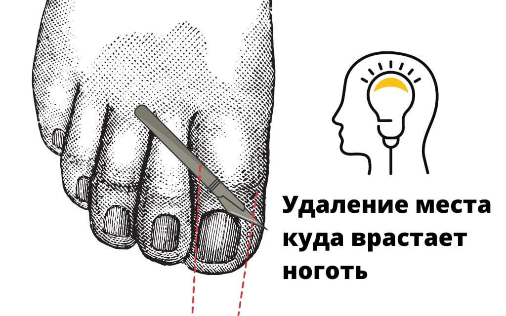 Вросший ноготь (онихокриптоз)