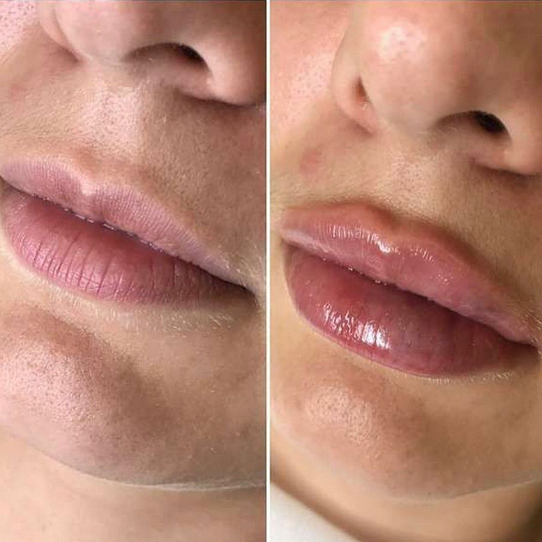 Контурная пластика губ, коррекция носогубных складок и лица, фото до и после.