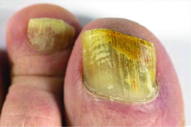 Микоз | грибок на ногах | чем опасен грибок ногтей и кожи стопы, виды и причины