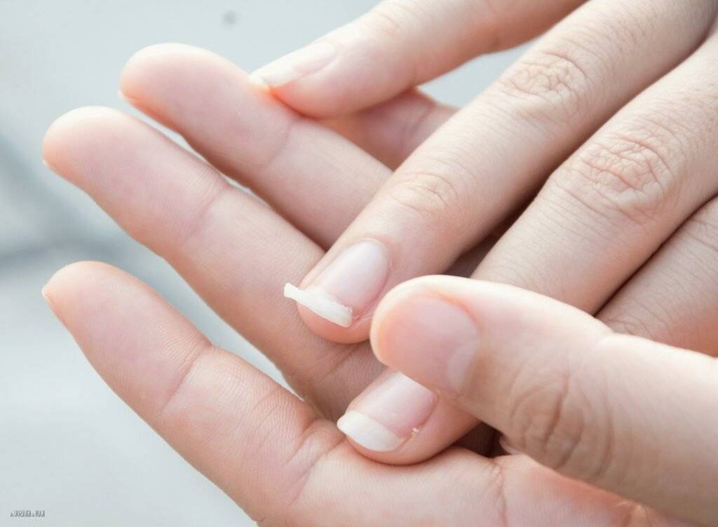Почему слоятся ногти на руках: причины расслоения у взрослых и детей